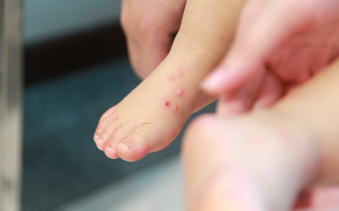 Bộ Y tế cảnh báo về tay chân miệng tăng nhanh với chủng EV71