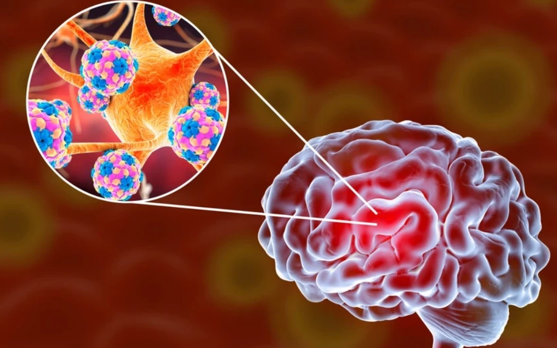Bệnh não mô cầu gia tăng: Trẻ em chiếm gần một nửa số ca mắc