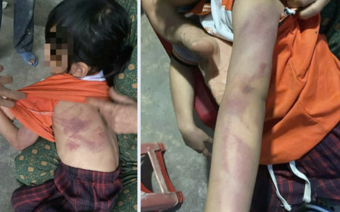 Học sinh lớp 2 dùng thước đánh bạn bầm tím khắp người