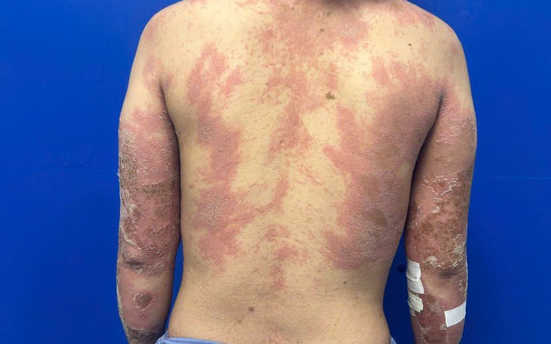 Nữ bệnh nhân dân tộc Mông đau đớn vì căn bệnh vảy nến mủ toàn thân