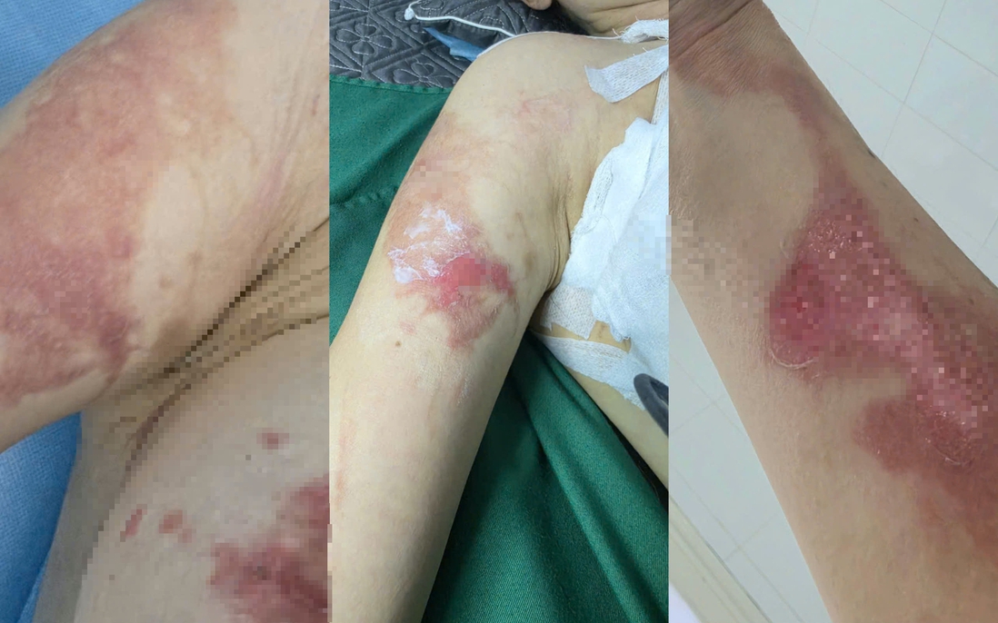Người phụ nữ tố bị bỏng khi sử dụng dịch vụ tại spa ở Hà Nội