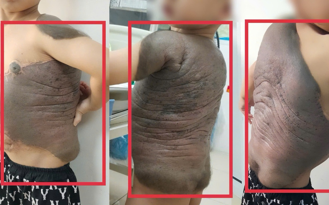 Bé trai mang khối u khổng lồ như "mai rùa", lần đầu tiên đứng thẳng lưng sau 7 năm