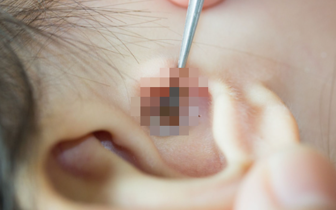 Bé gái 2 tuổi bị bọ chét ký sinh trên màng nhĩ