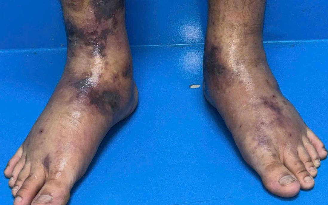 Bệnh viện Da liễu Trung ương điều trị thành công ca viêm mạch hiếm gặp