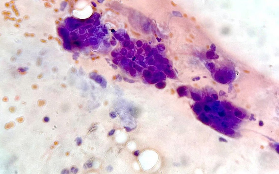 Hơn 7% mẫu sàng lọc dương tính với HPV nguy cơ cao, nhiều ca không có triệu chứng