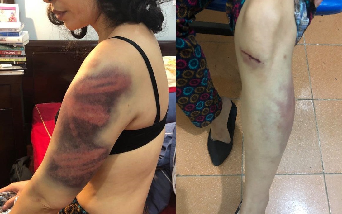 Hà Nội: Một phụ nữ kêu cứu vì bị đánh đập dã man