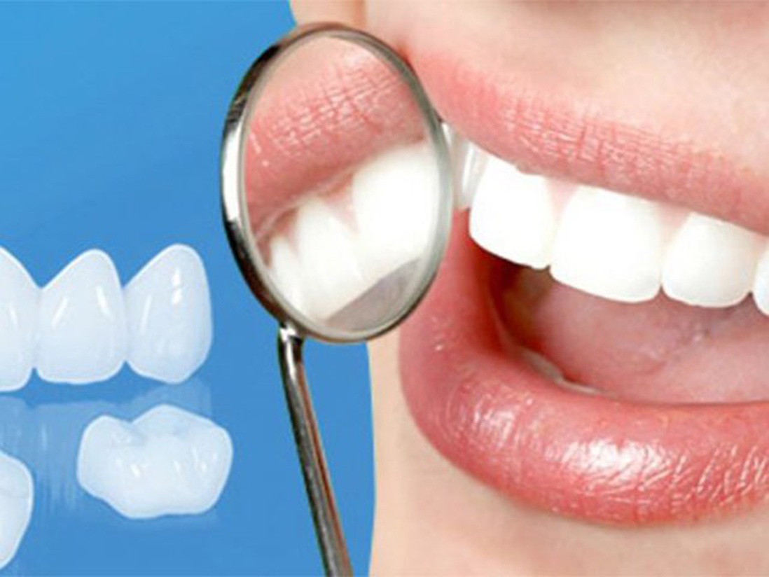 Bọc sứ thẩm mỹ để có hàm răng trắng và nụ cười hoàn hảo, nên hay không?