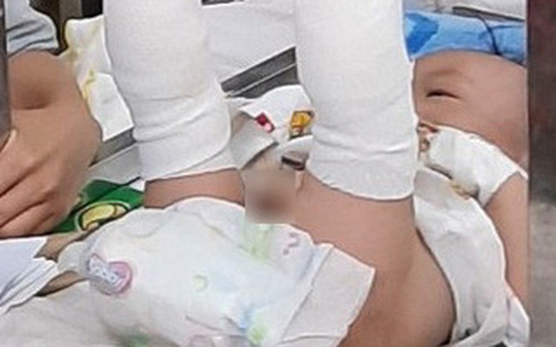 Bé trai 4 tháng tuổi nghi bị cha ruột đánh gãy chân, bầm tím khắp người, xuất huyết não