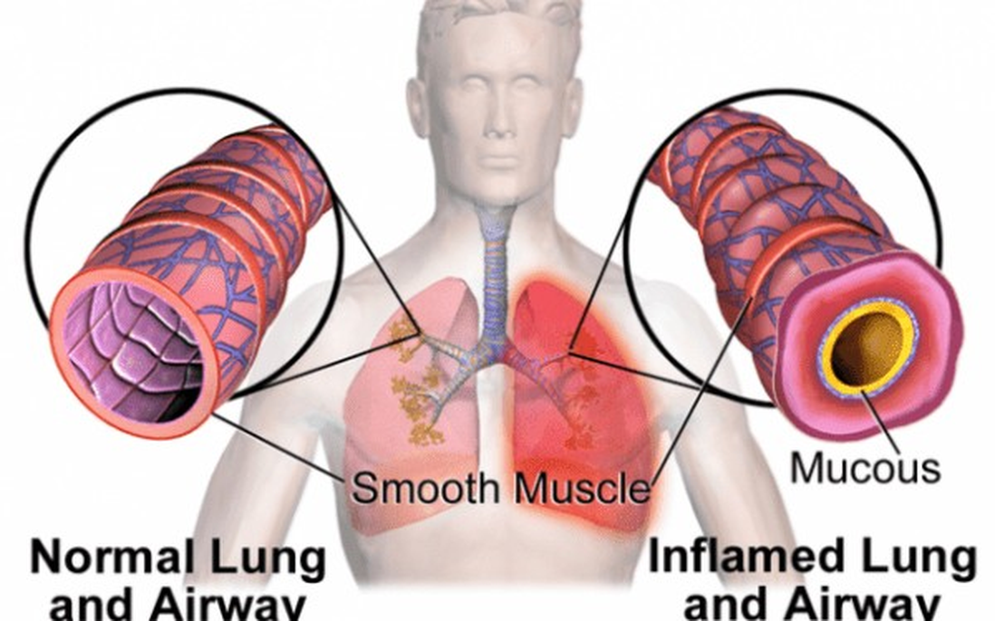 5 cách làm tiêu đờm nhanh nhất và những lưu ý không phải ai cũng biết