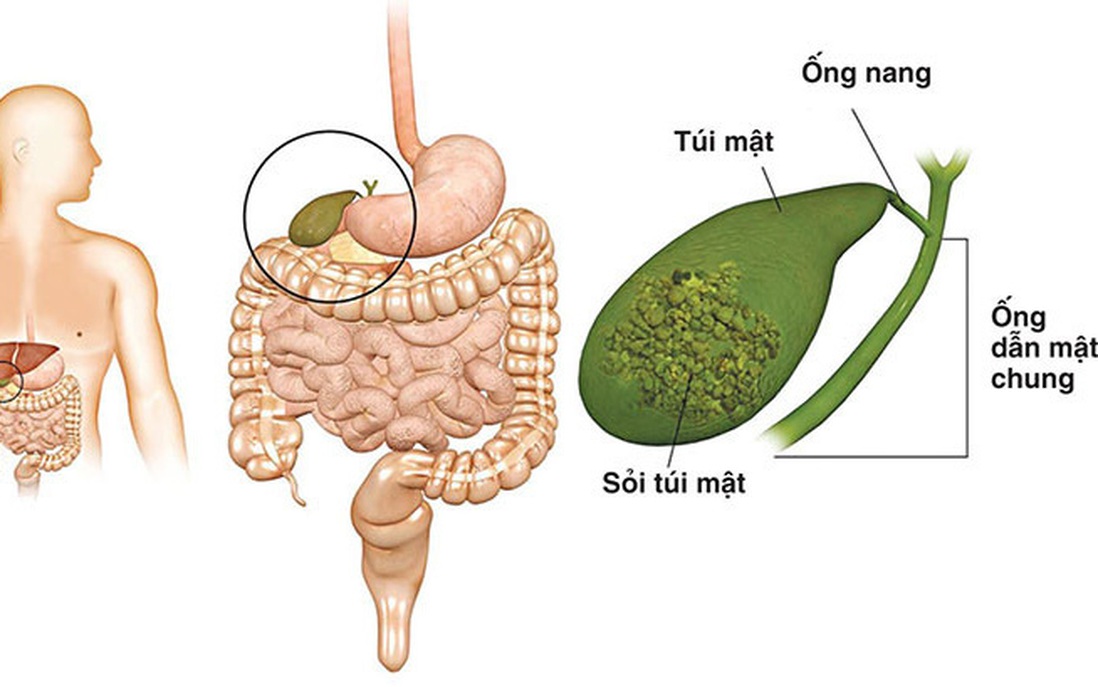 Bệnh ung thư túi mật: Nguy hiểm cần được phát hiện và điều trị kịp thời