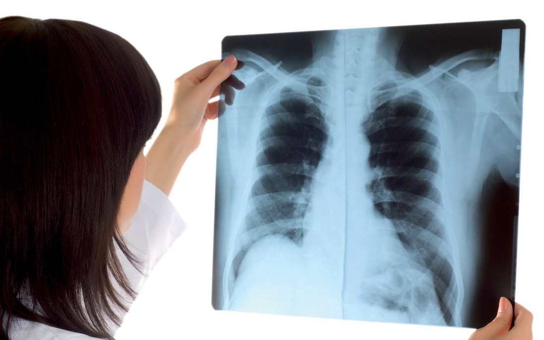 Những điều cần biết về chụp X-quang phổi