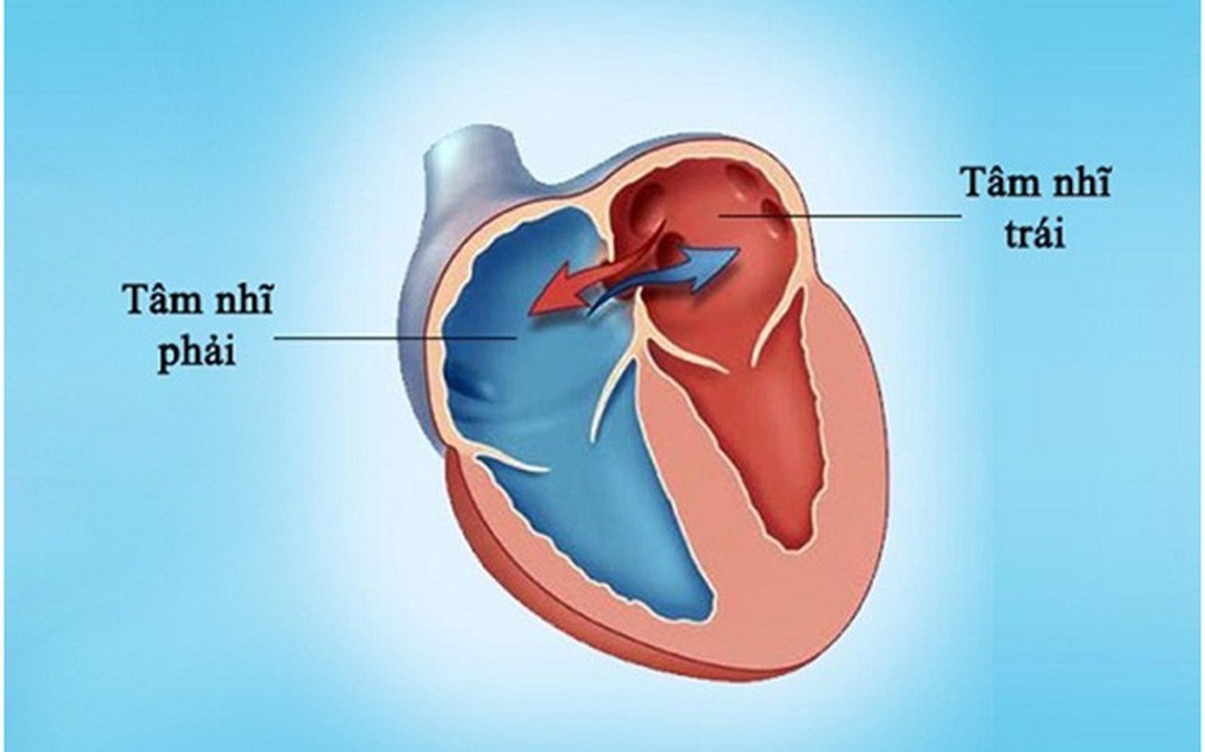 Bệnh tim bẩm sinh là gì? Tìm hiểu chung về bệnh tim bẩm sinh