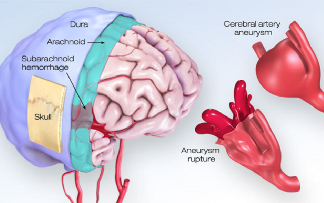 Phình mạch máu não là gì? Cần phát hiện sớm để tránh tử vong