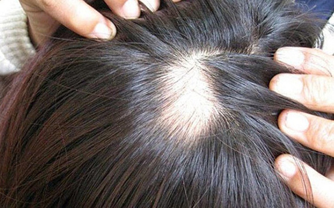 10 điều bạn nên biết về chứng rụng tóc, hói đầu