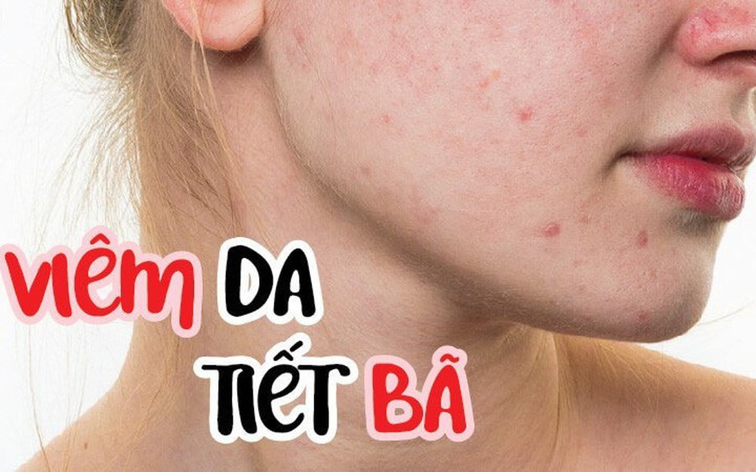 Viêm da tiết bã: Nguyên nhân, triệu chứng và cách phòng tránh