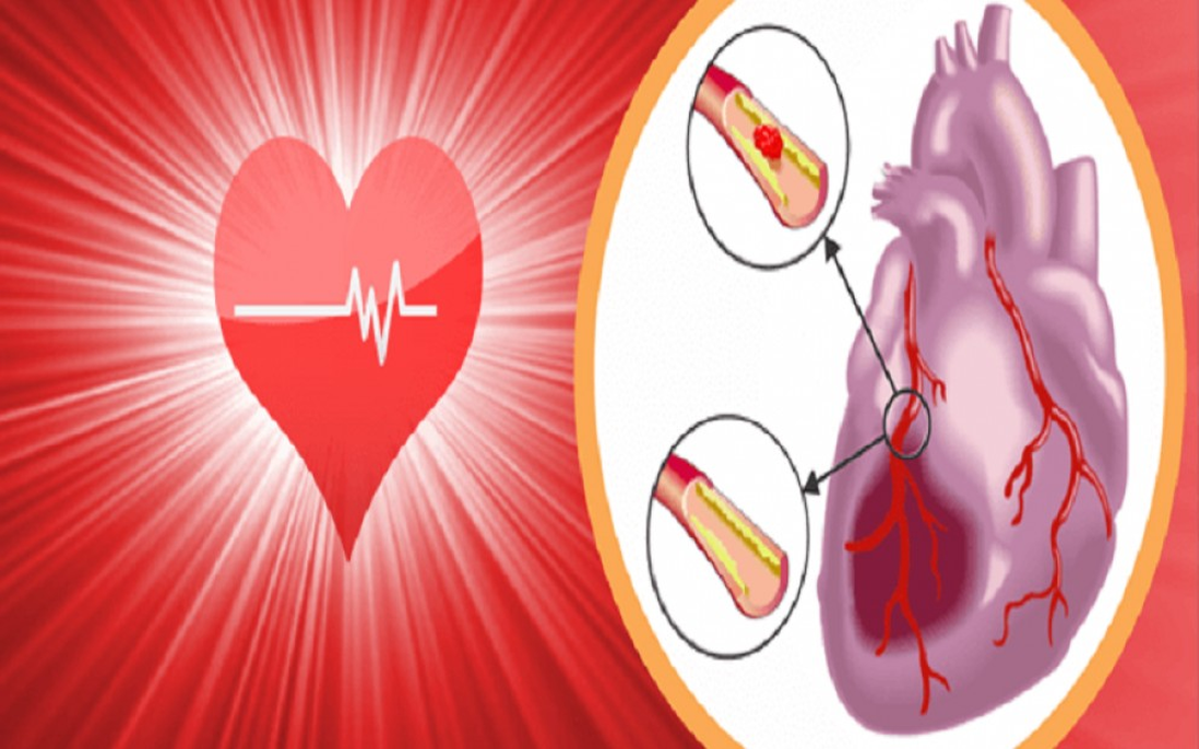 Bệnh thiếu máu cơ tim là gì? Dấu hiệu, nguyên nhân và cách điều trị