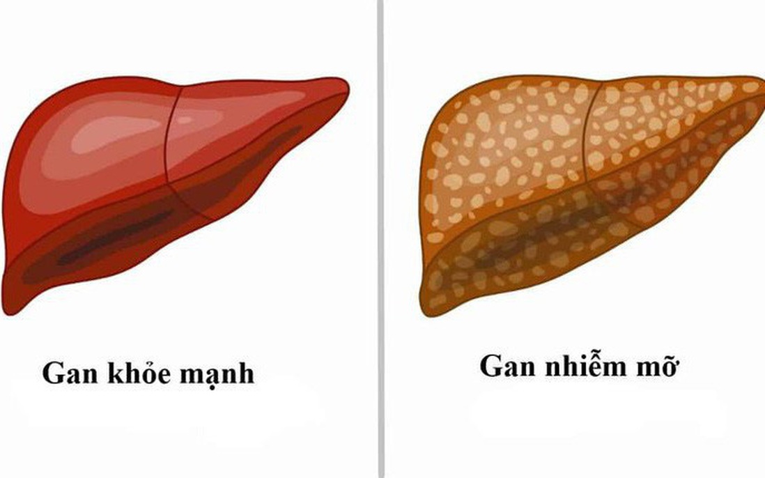 Khi nào nên đi xét nghiệm gan nhiễm mỡ?