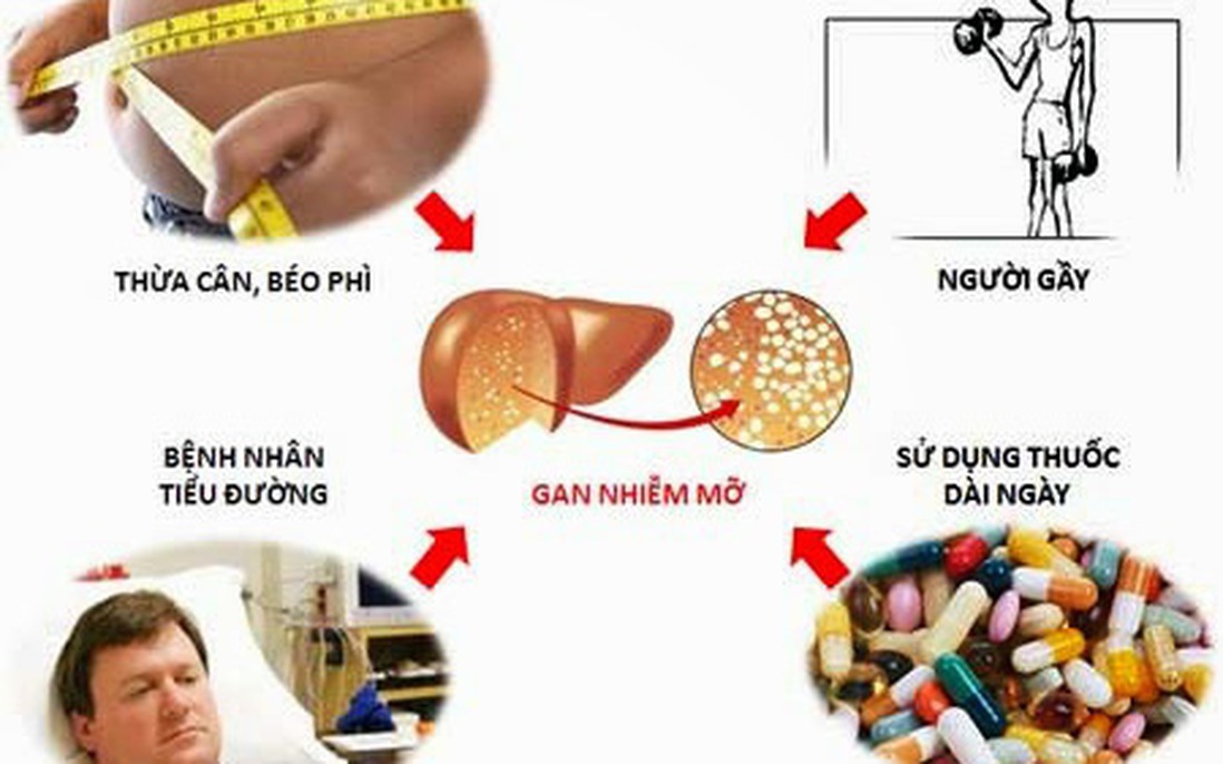 Tổng hợp những hiểu lầm về gan nhiễm mỡ thường gặp