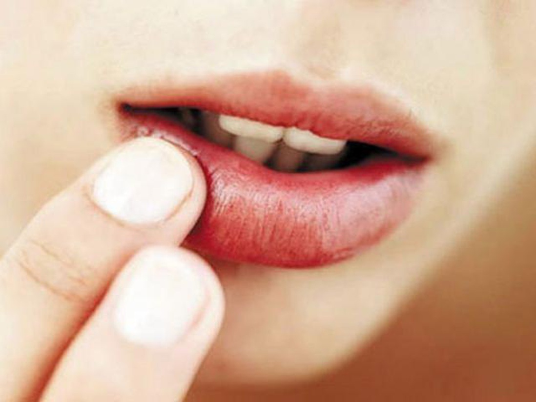 4 dấu hiệu xuất hiện trên miệng cảnh báo phụ nữ có thể đang mắc bệnh phụ khoa