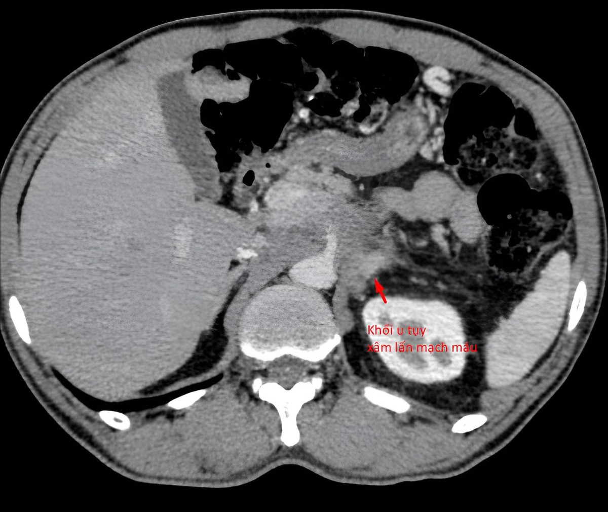 Bệnh nhân được cứu sống sau 3 tuần “bỏ đói”, sụt 14 kg để chữa ung thư- Ảnh 1.