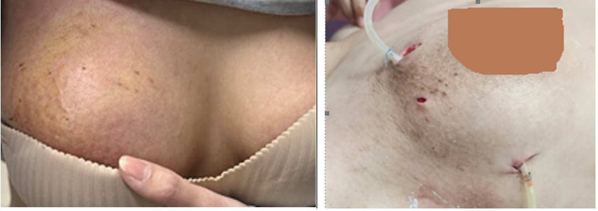 Áp xe vú nguy hiểm sau tiêm filler nâng ngực- Ảnh 1.