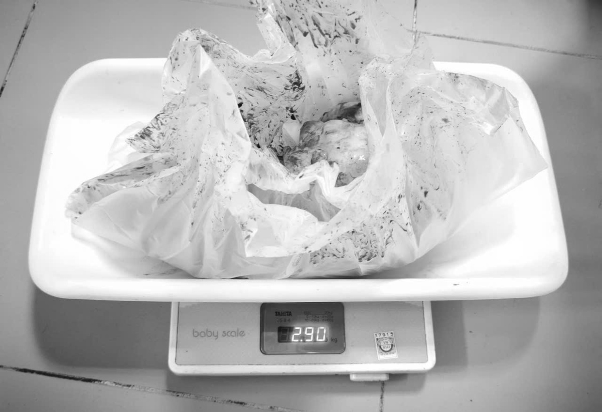 Cô gái 20 tuổi phát hiện khối u khổng lồ trong ổ bụng - Ảnh 1. Cô gái 20 tuổi phát hiện khối u khổng lồ trong ổ bụng - Ảnh 1.