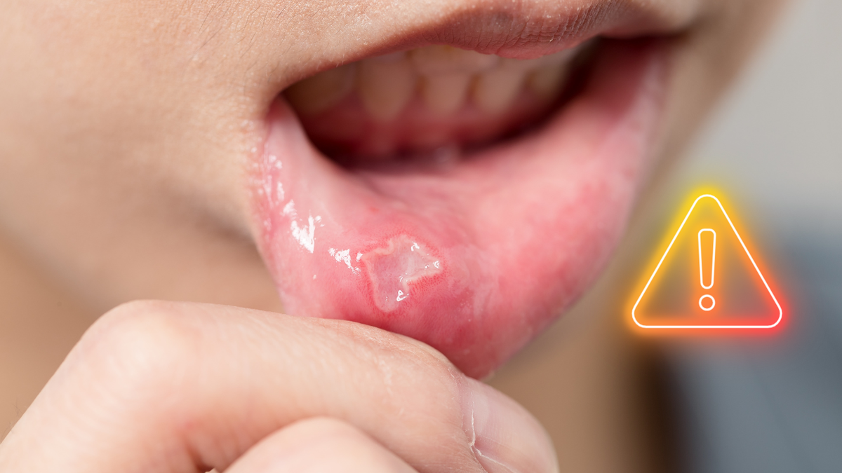 Ăn mặn, cay thời gian dài gây tổn thương mạn tính niêm mạc khoang miệng, dễ dẫn đến ung thư- Ảnh 1. Ăn mặn, cay thời gian dài gây tổn thương mạn tính niêm mạc khoang miệng, dễ dẫn đến ung thư- Ảnh 1.