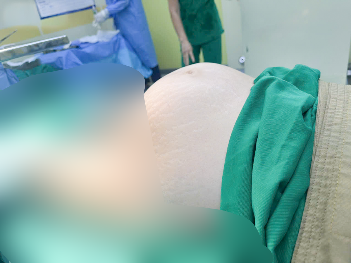 Phẫu thuật lấy khối u xơ tử cung to bằng quả bóng chuyền - Ảnh 1.