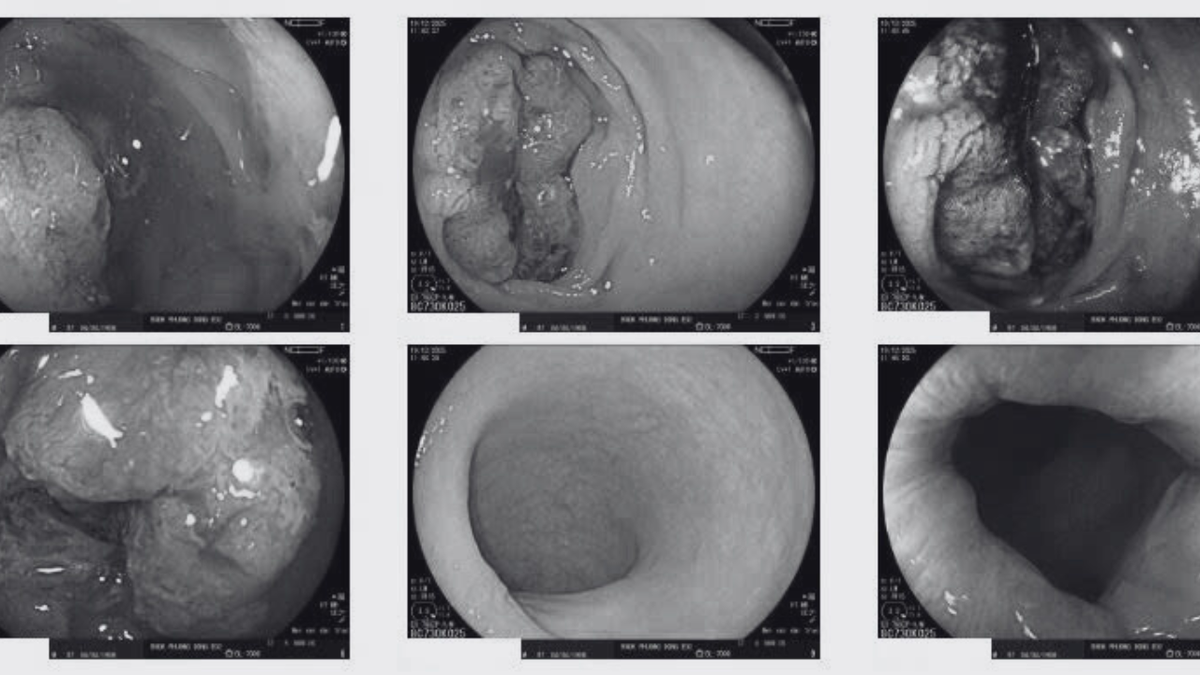 Tin “chữa lành” bỏ hóa trị, bệnh nhân ung thư nhập viện vì suy kiệt- Ảnh 1. Tin “chữa lành” bỏ hóa trị, bệnh nhân ung thư nhập viện vì suy kiệt- Ảnh 1.