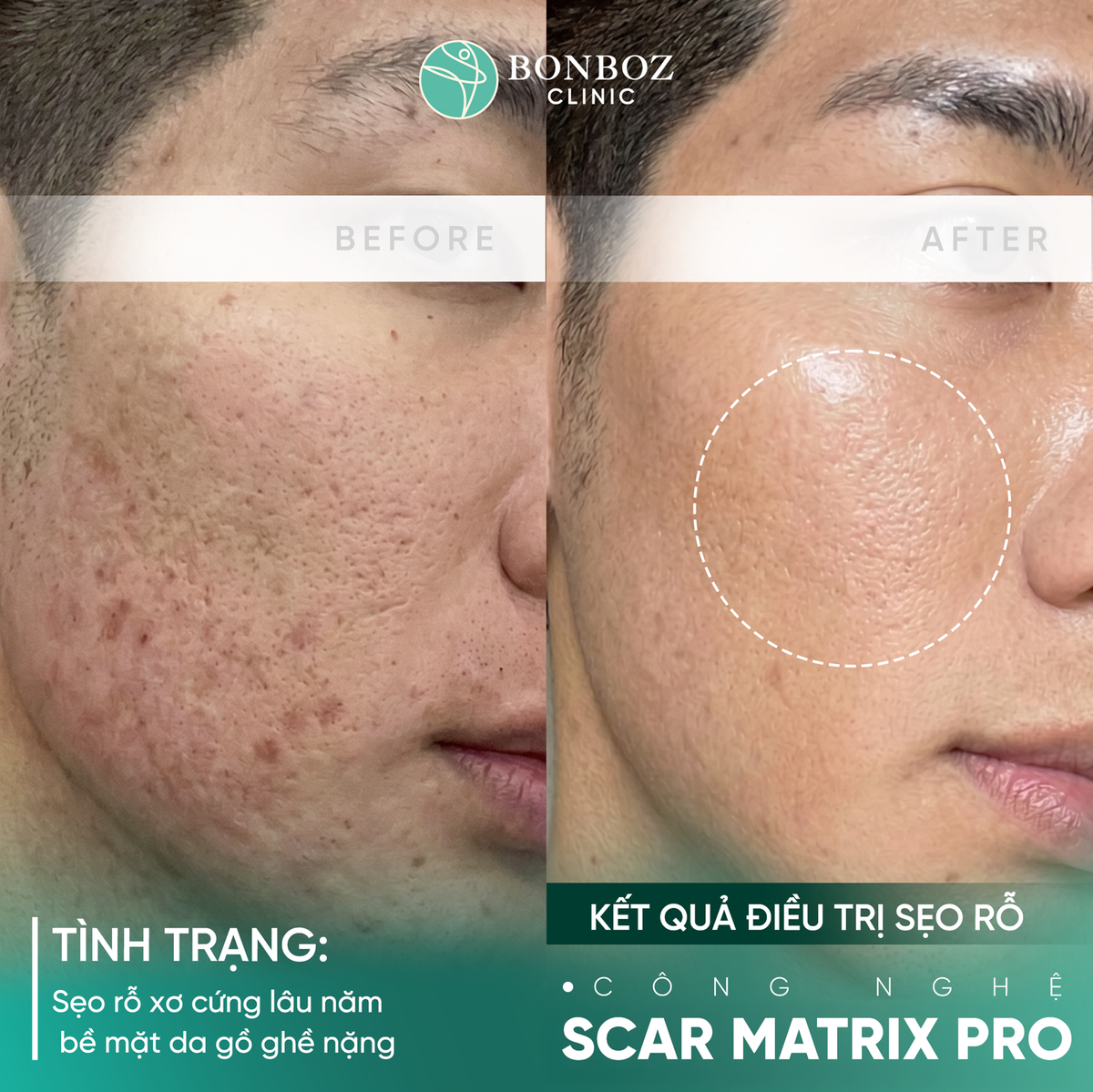 BonBoZ: Điều trị sẹo rỗ bắt đầu từ việc hiểu đúng cấu trúc sẹo- Ảnh 3.