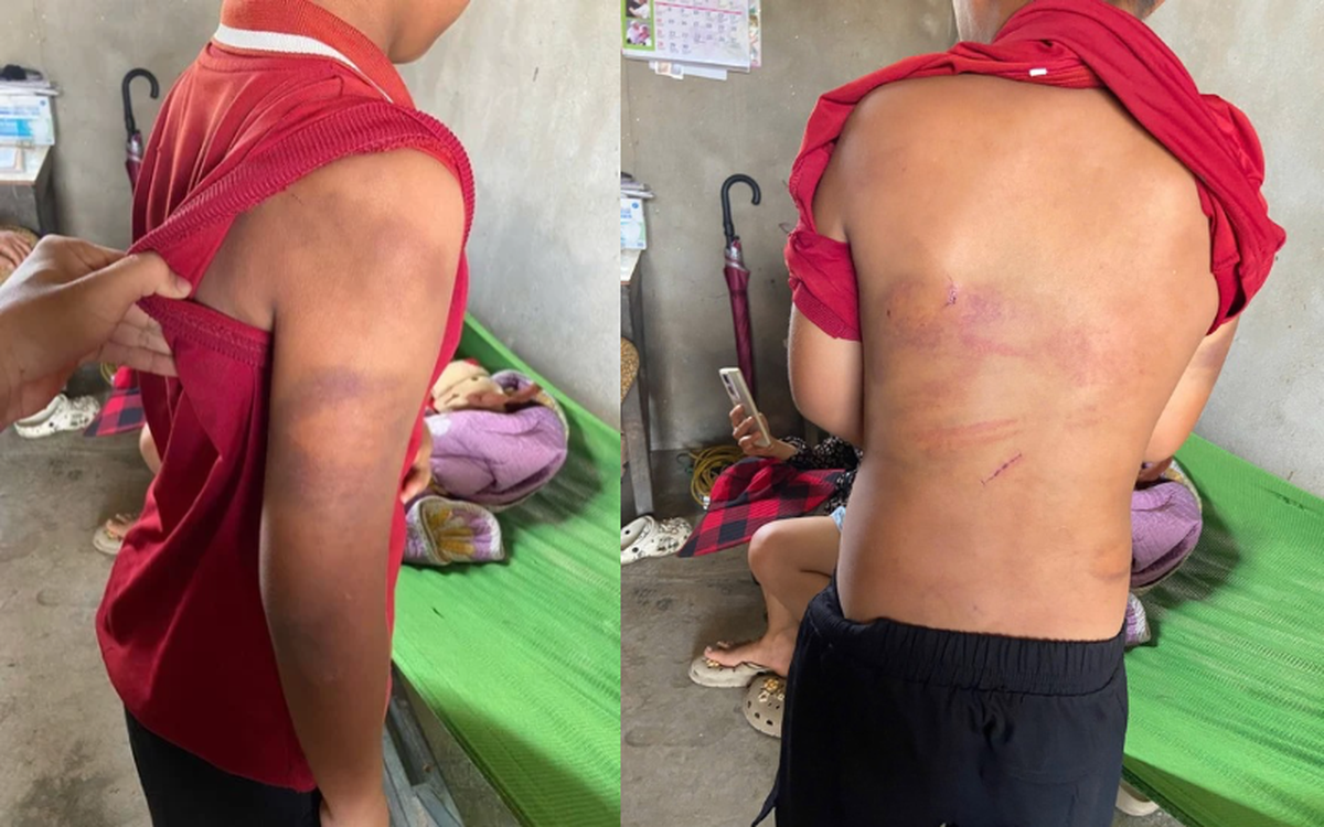 Vụ bé trai 10 tuổi bị bạo hành ở Nghệ An: Người cha sắp hầu tòa - Ảnh 2.