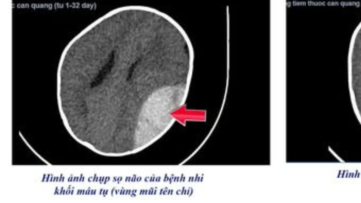 Ngã xe tập đi, bé 8 tháng tuổi nguy kịch vì tụ máu não- Ảnh 1.