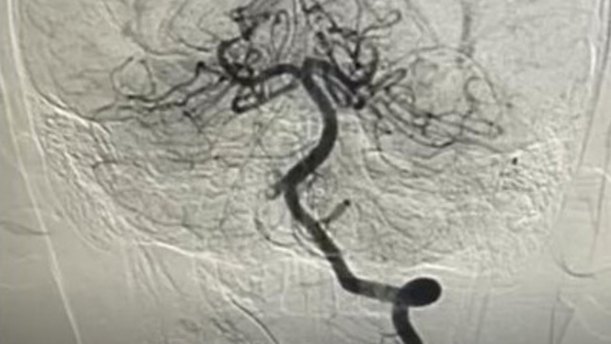 Bé trai 10 tuổi bất ngờ đột quỵ sau khi chơi thể thao- Ảnh 1.