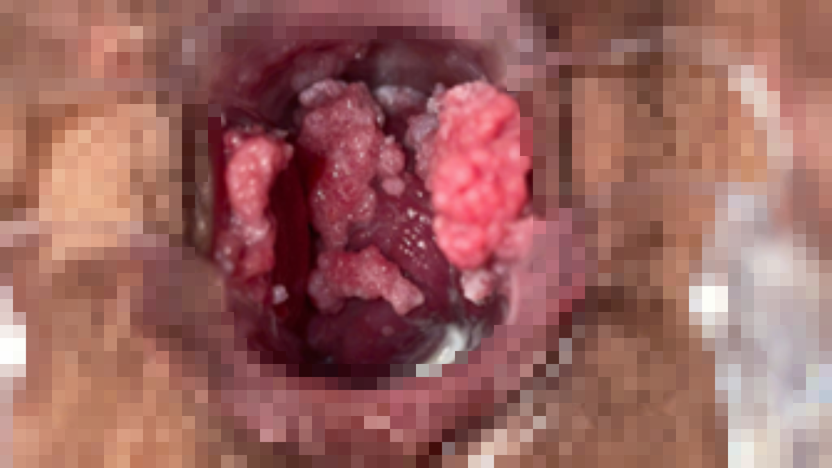 Điều trị thành công sùi mào gà cho phụ nữ mang thai- Ảnh 1.