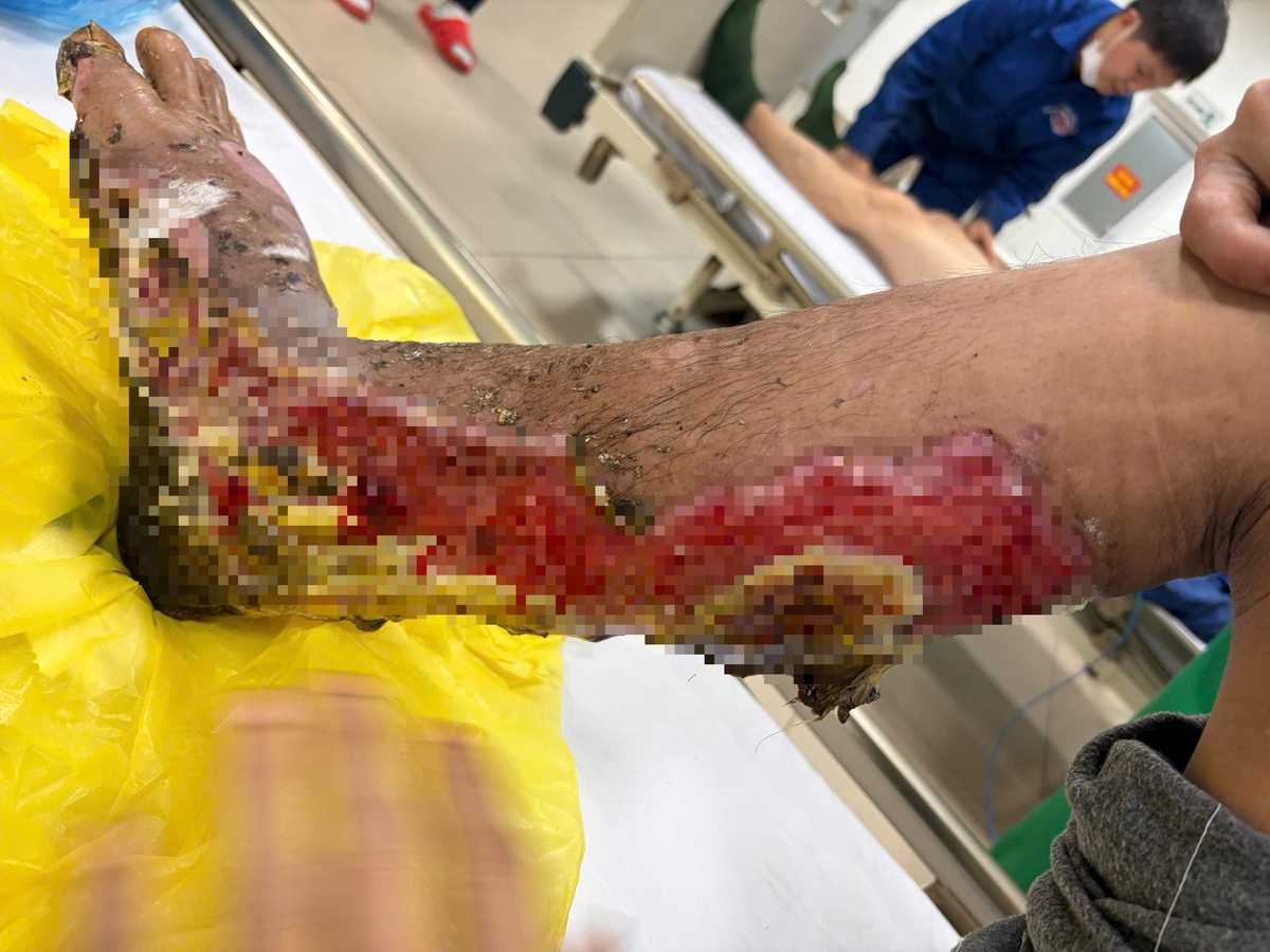 Suýt mất chân vì tự đắp lá chữa bỏng lửa suốt một tháng- Ảnh 1.