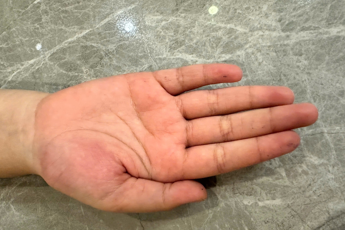 Huế: Học sinh lớp 4 bị chấn thương tay, cô giáo nhận đã 