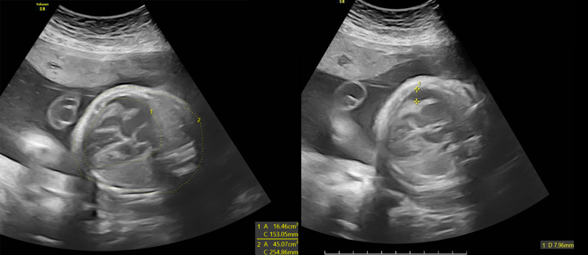 Nhiễm CMV từ trong bụng mẹ, thai nhi đối diện với hàng loạt biến chứng nặng- Ảnh 1.