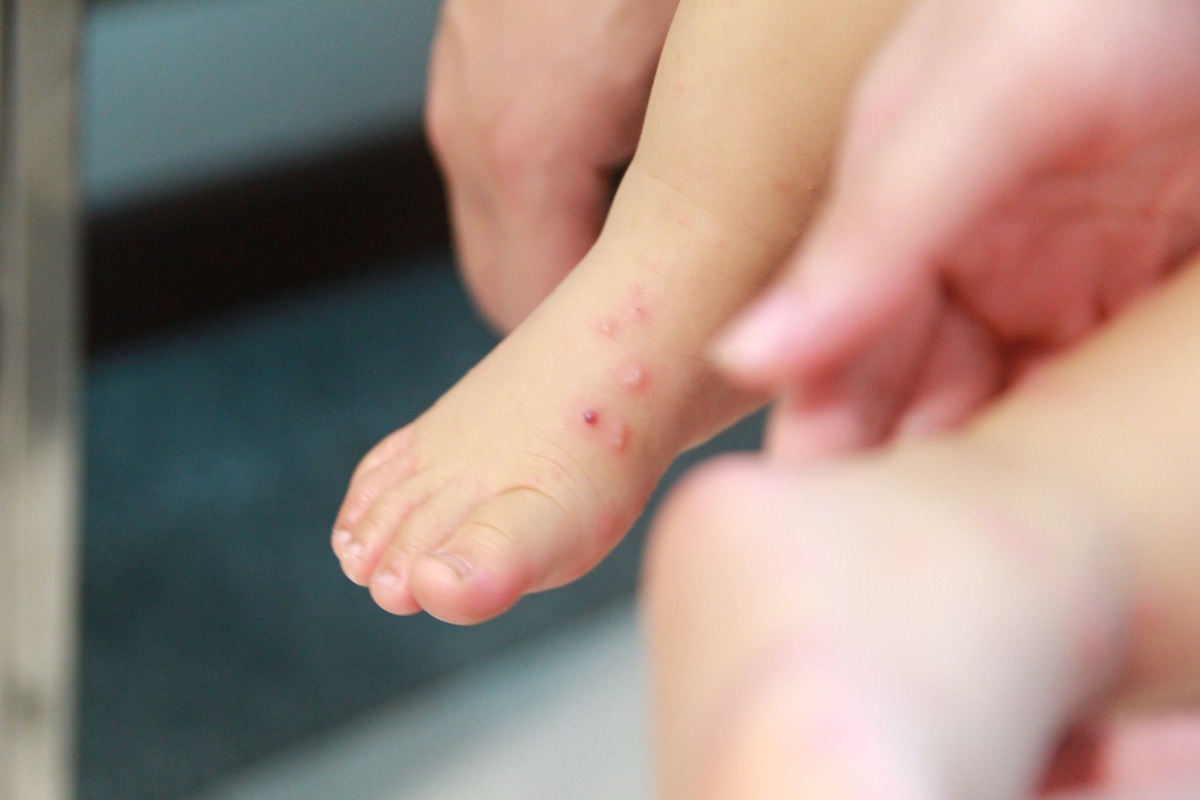 Chủ động nguồn thuốc, siết điều trị và giám sát để giảm tử vong tay chân miệng- Ảnh 1.