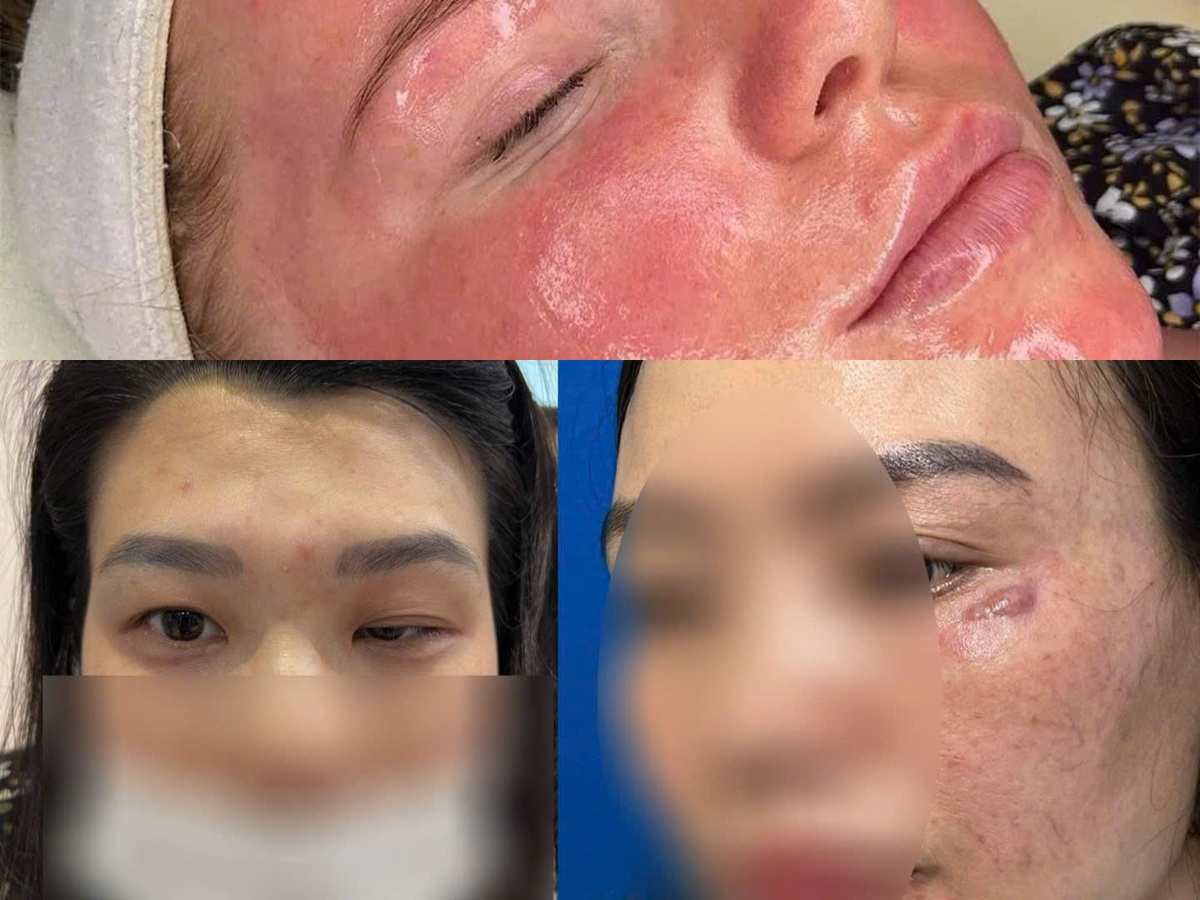 Thẩm mỹ tăng trưởng nóng: Cảnh báo từ các ca biến chứng- Ảnh 1.