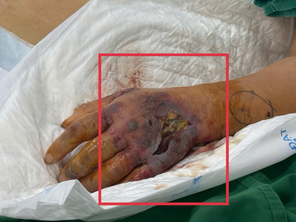 Sốc nhiễm trùng, suy đa tạng từ mũi tiêm trên da ở phòng khám tư- Ảnh 1.