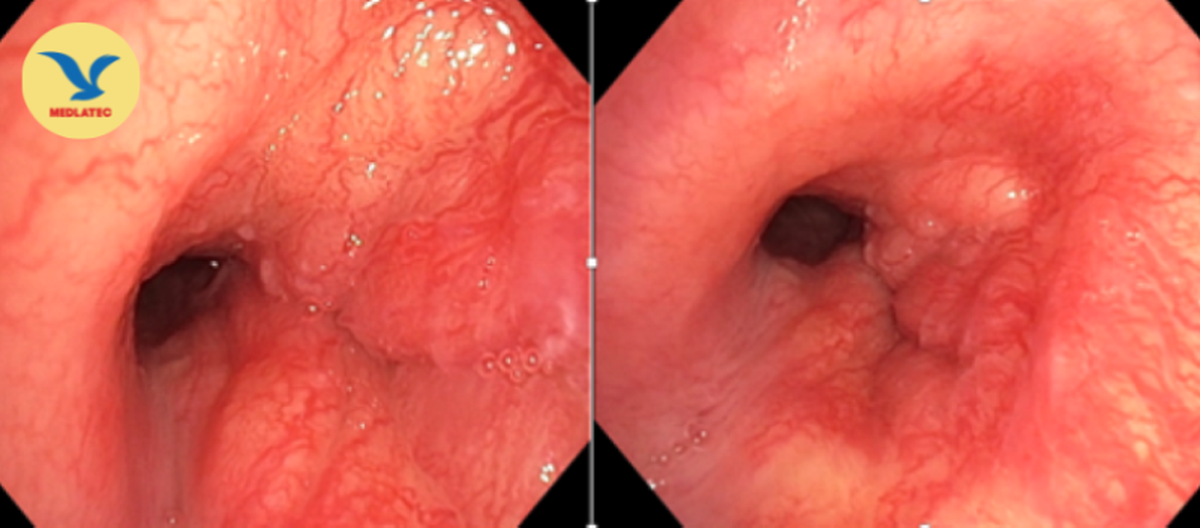 Chuyên gia kiên trì thuyết phục bệnh nhân thực hiện sinh thiết, phát hiện ung thư phổi hiếm gặp- Ảnh 2.