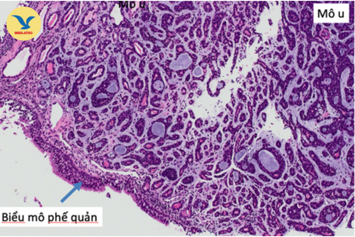 Chuyên gia kiên trì thuyết phục bệnh nhân thực hiện sinh thiết, phát hiện ung thư phổi hiếm gặp- Ảnh 3.