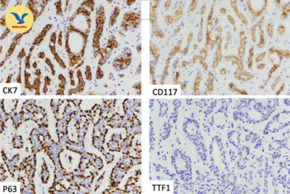 Chuyên gia kiên trì thuyết phục bệnh nhân thực hiện sinh thiết, phát hiện ung thư phổi hiếm gặp- Ảnh 4.