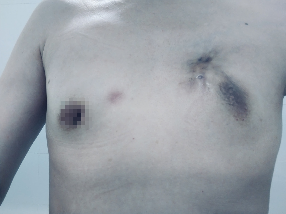 Cá thể hóa điều trị mở ra hy vọng cho người bệnh ung thư vú giai đoạn IV- Ảnh 1.