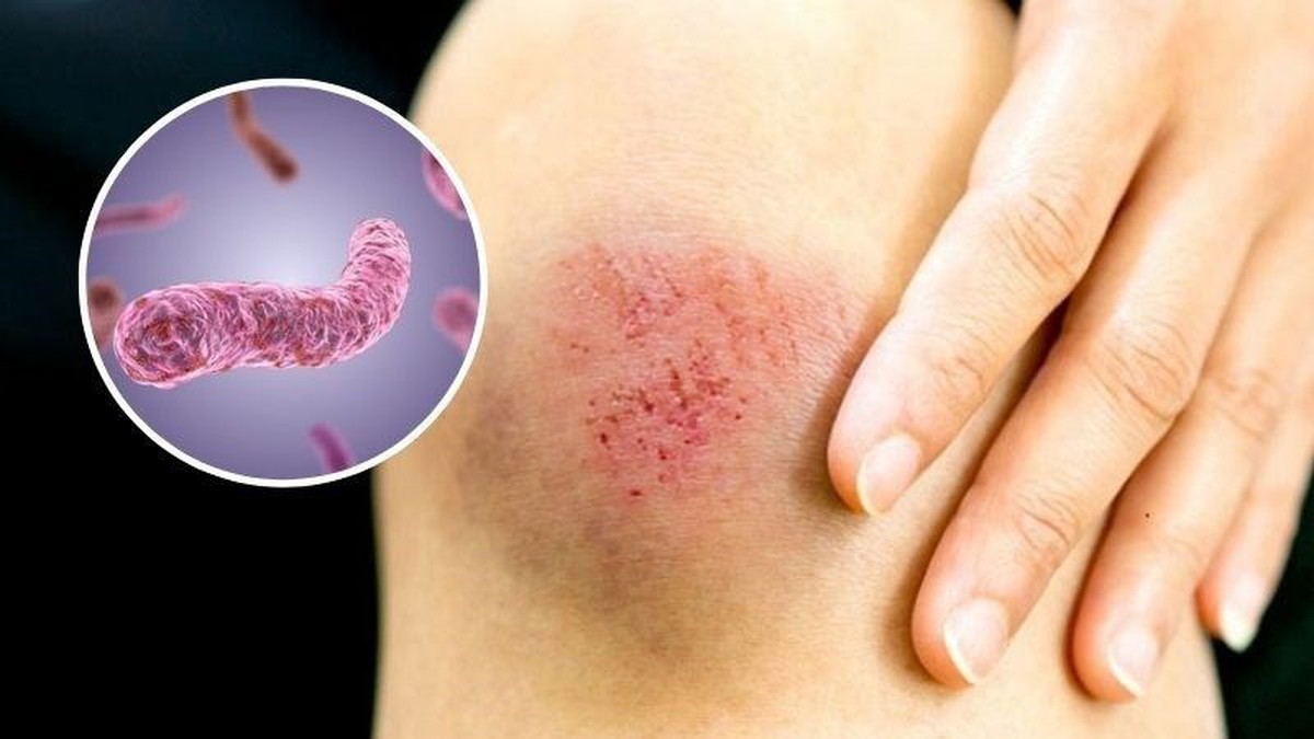 Bộ Y tế khuyến cáo bệnh từ bùn đất dễ bùng lên sau mưa lũ- Ảnh 1.