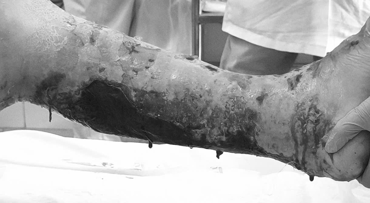 Hoại tử nguy kịch vì bôi dầu gió và chườm đá lạnh vào vết xước nhỏ- Ảnh 2.