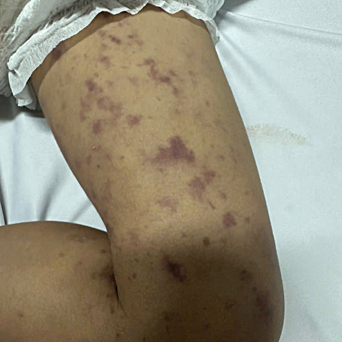 Đắk Lắk khẩn trương phòng dịch sau ca tử vong do viêm não mô cầu- Ảnh 1.