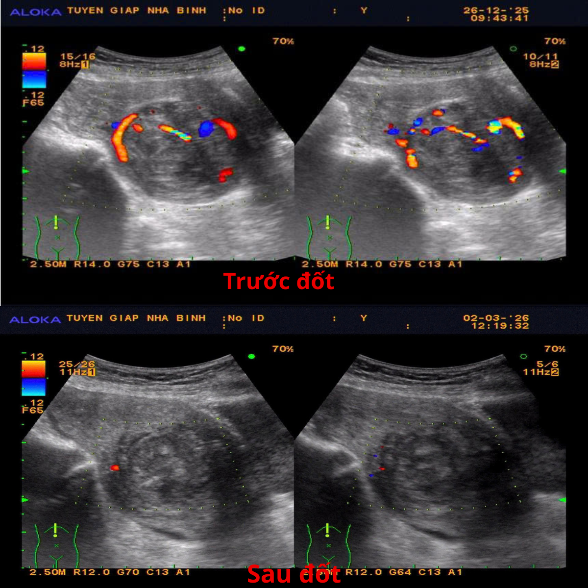 Bác sĩ Nhà Binh tiên phong đốt u xơ tử cung bằng sóng cao tần (RFA)- Ảnh 1.
