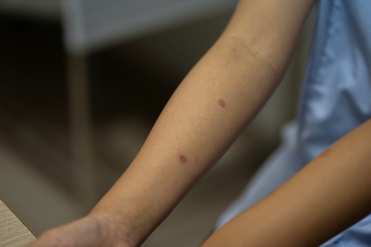 Nắng nóng đầu hè: Số ca nấm da, viêm nang lông tăng vọt- Ảnh 1.