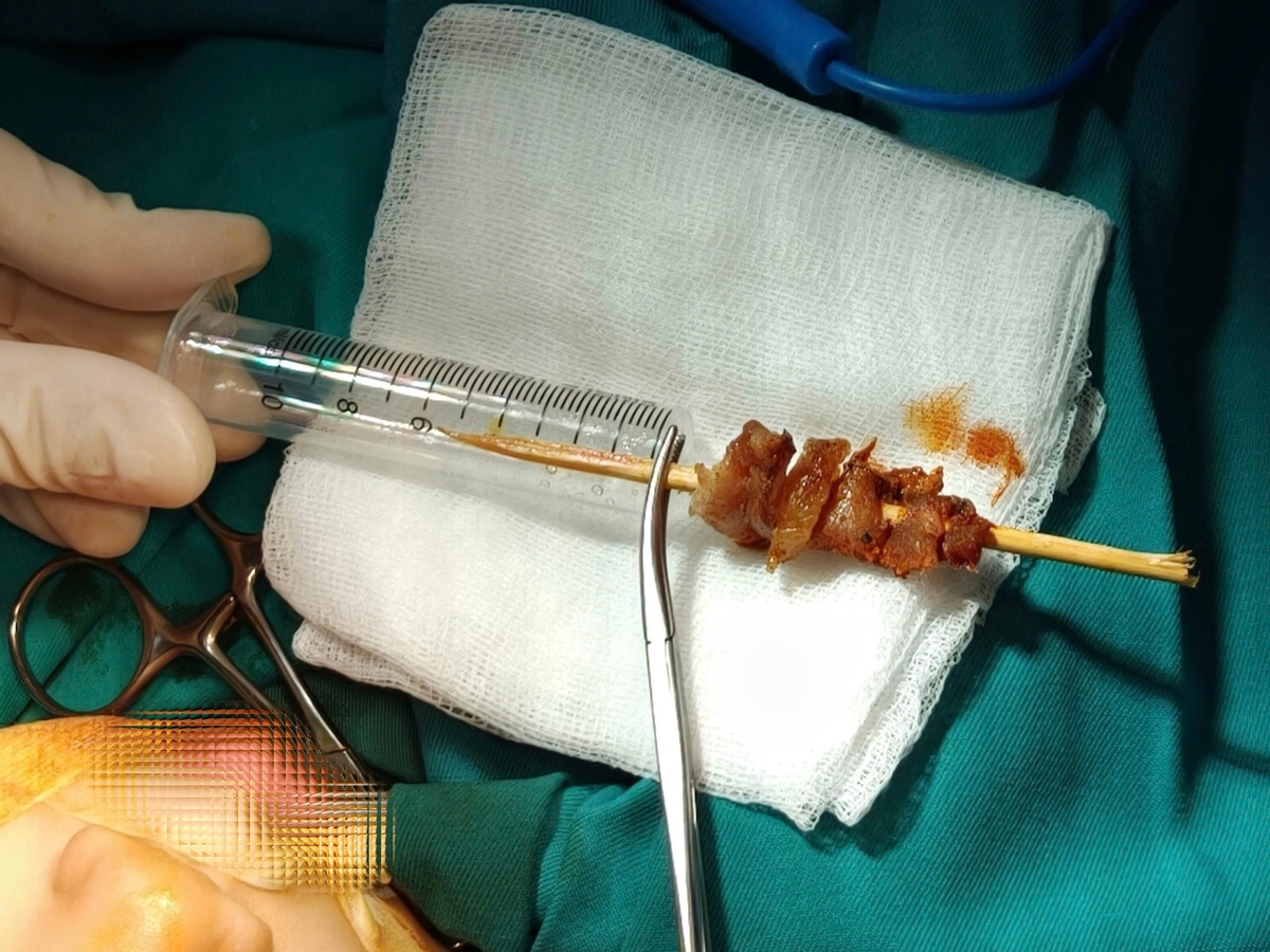 Que xiên thịt đâm xuyên vùng mắt bé gái 2,5 tuổi, gần chạm nền sọ não- Ảnh 1. Que xiên thịt đâm xuyên vùng mắt bé gái 2,5 tuổi, gần chạm nền sọ não- Ảnh 1.